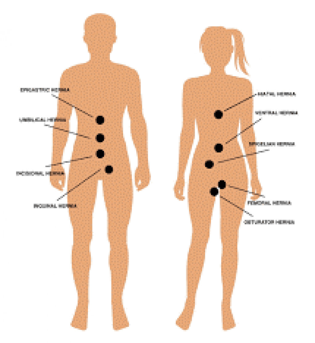 femoral hernia male